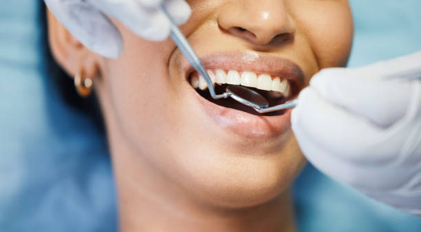 Emergency Dental Filling Replacement in IN