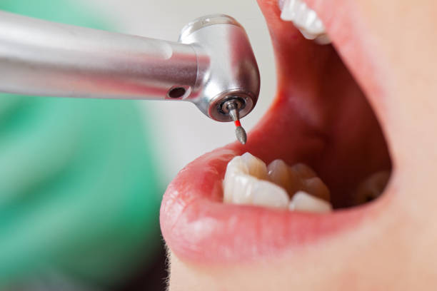 Best Chipped Tooth Repair Near Me  in Westport, IN